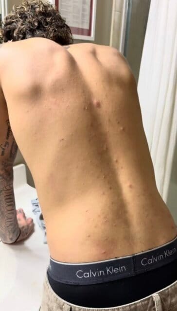 Customer photo review of Lucrown Body Acne Wash