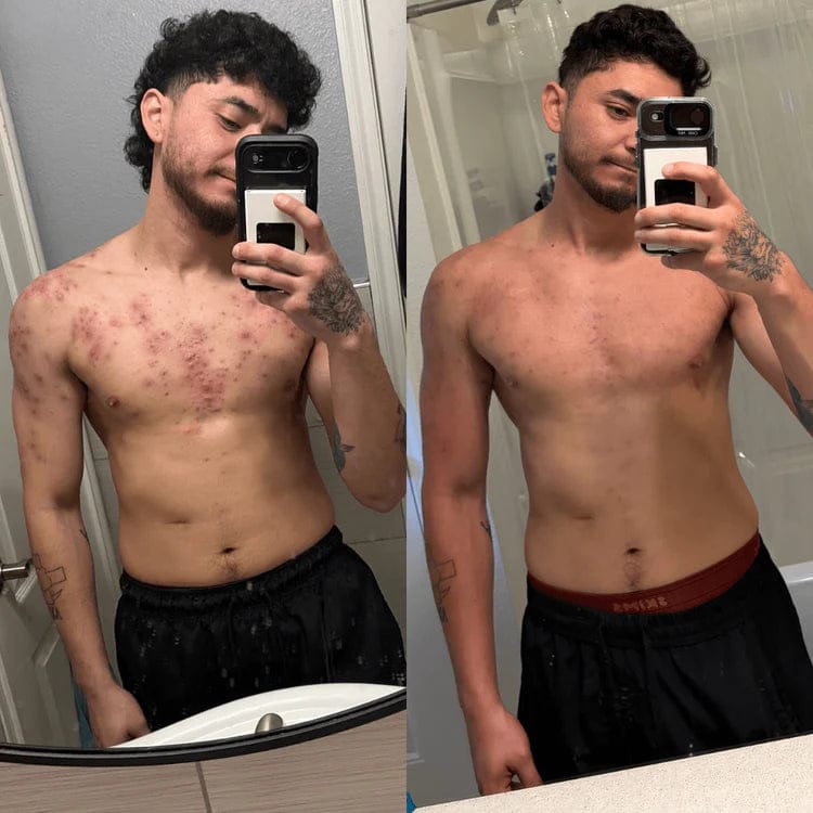 Customer photo review of Lucrown Body Acne Wash