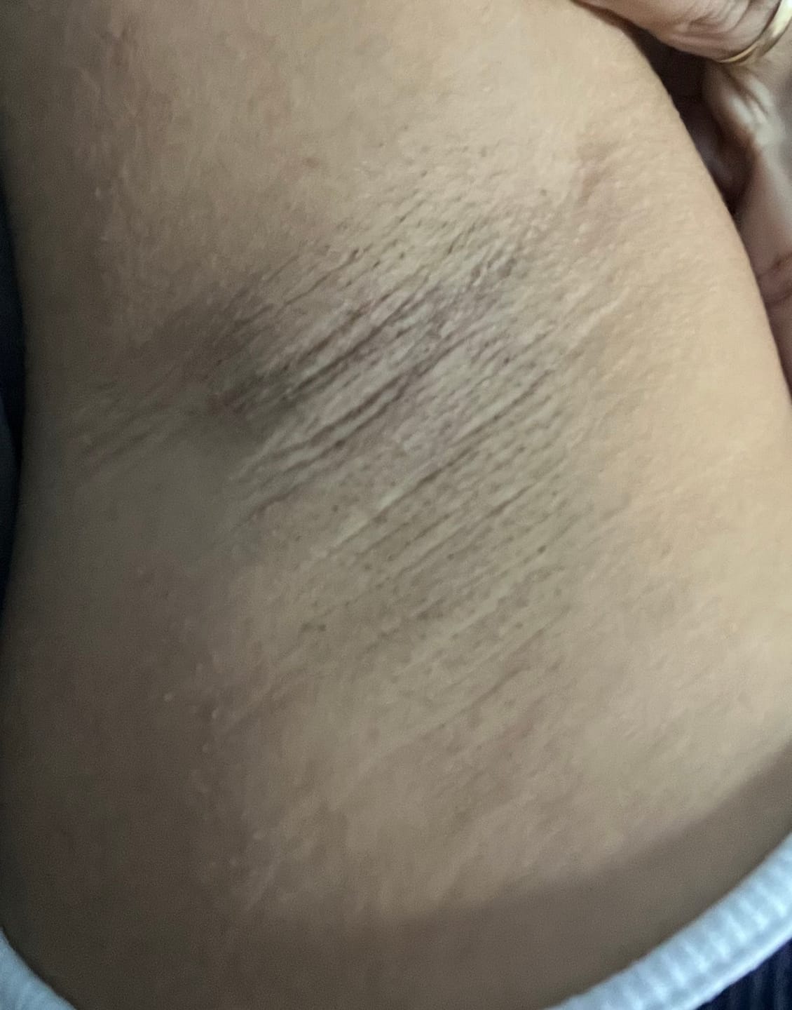 Customer photo review of Creme Clareador de Manchas – Melasma, Axilas, Virilha, Áreas Íntimas, Rosto e Corpo