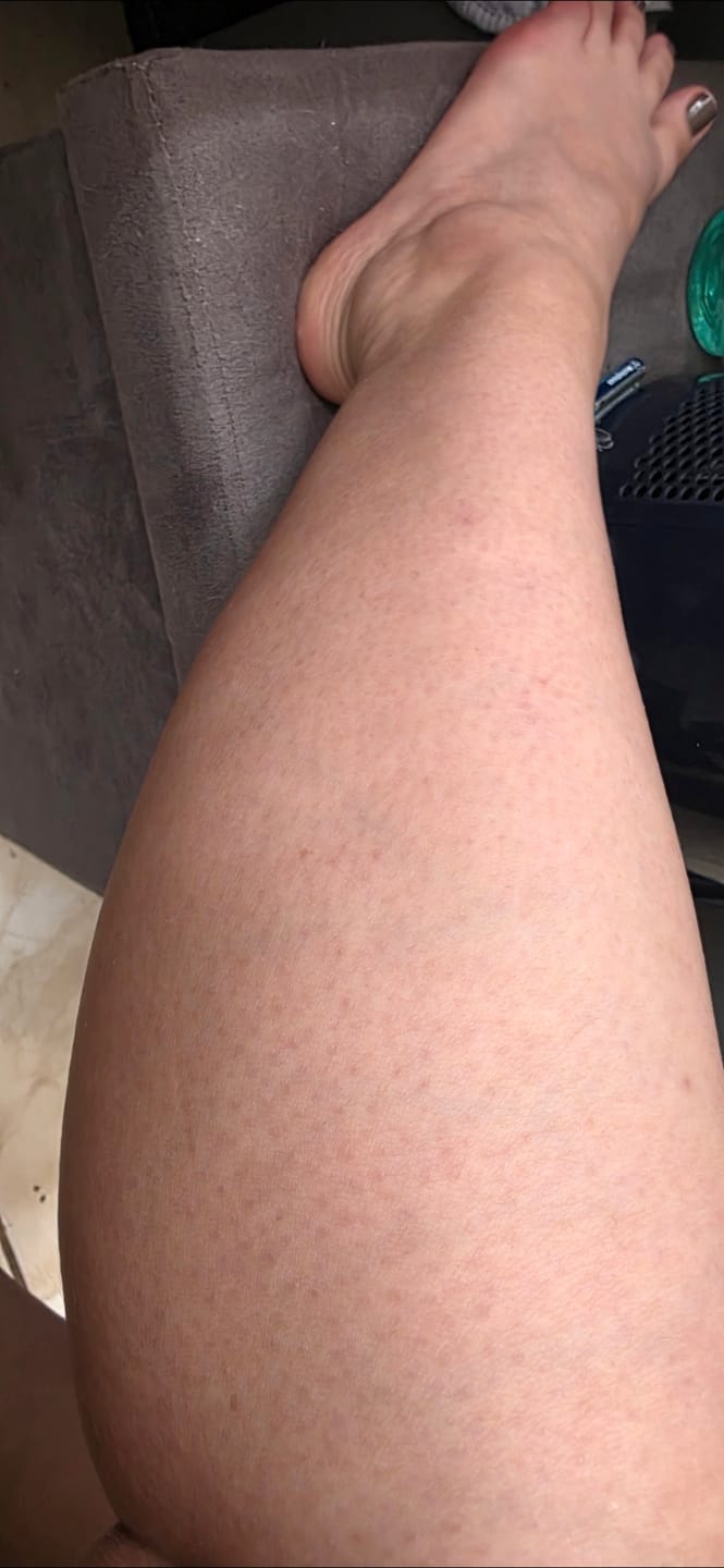 Customer photo review of Depiladora Premium IPL