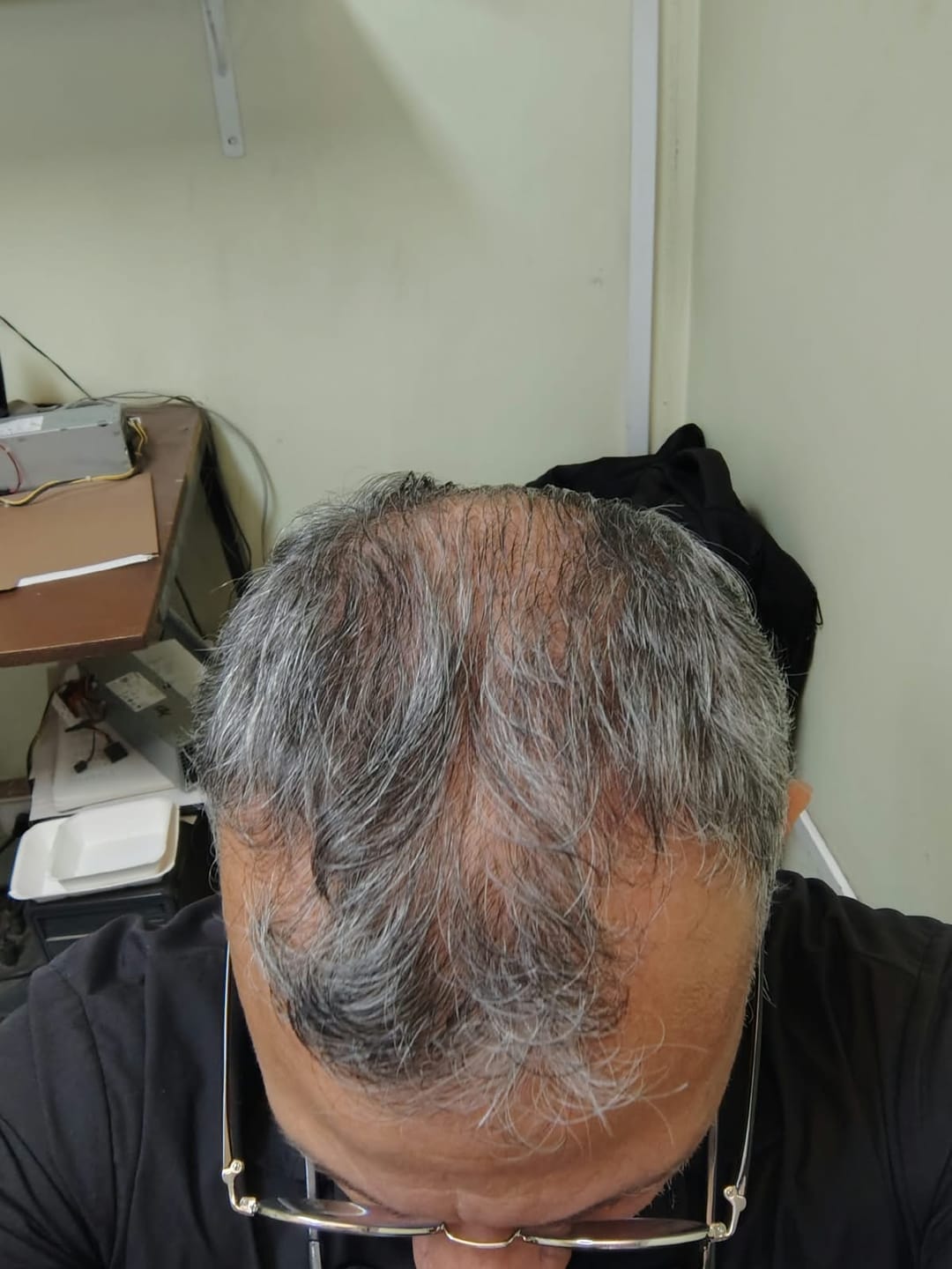 Customer photo review of 3 Tónicos Capilares de Romero · Crecimiento y Anticaída + Dermaroller de regalo