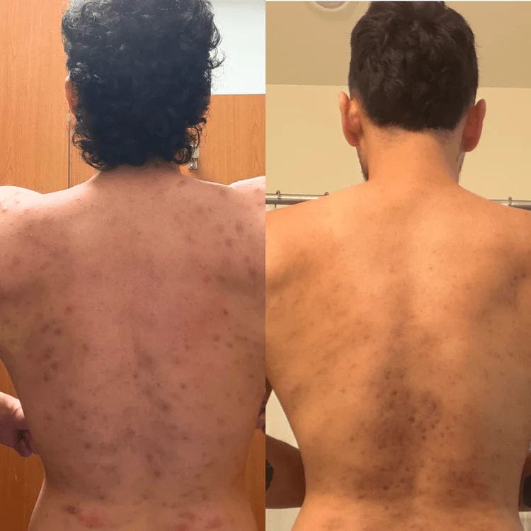 Customer photo review of Lucrown Body Acne Wash