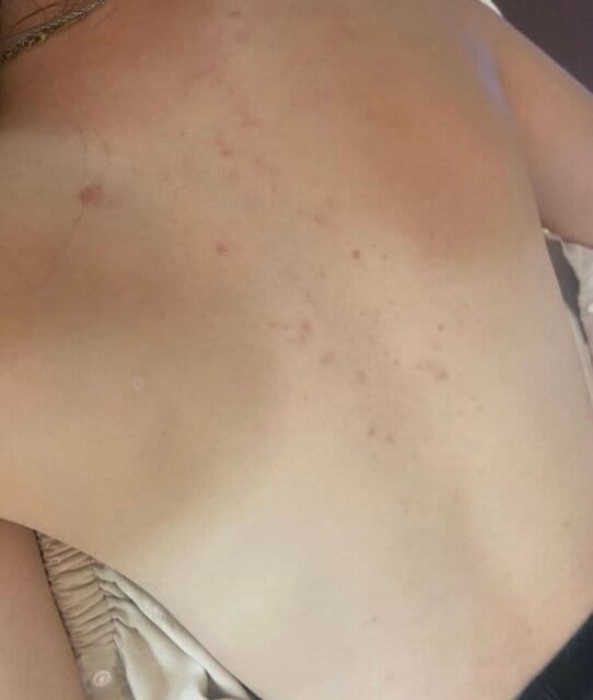 Customer photo review of Lucrown Body Acne Wash