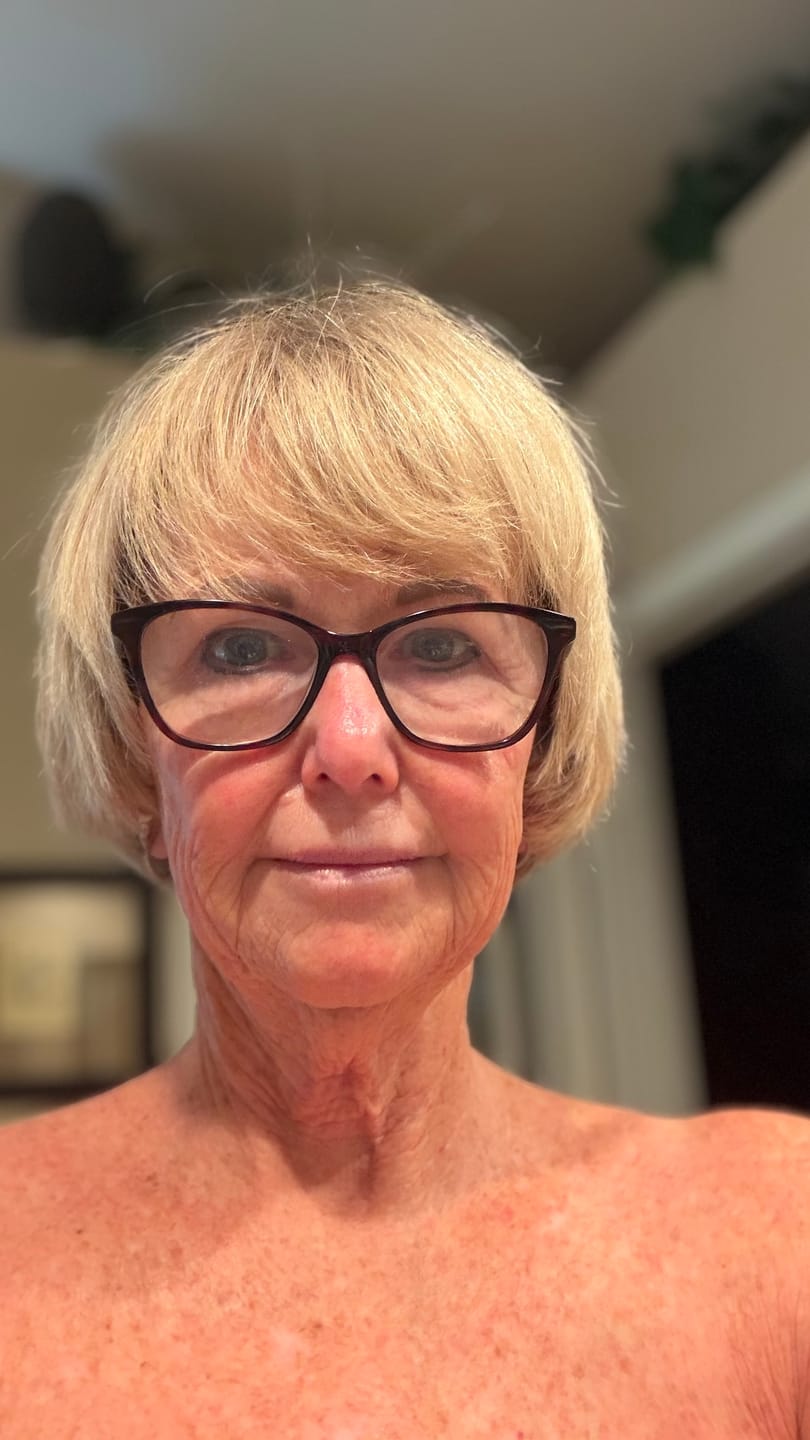 Customer photo review of 3 Month Supply - Seranova Micro Infusion System