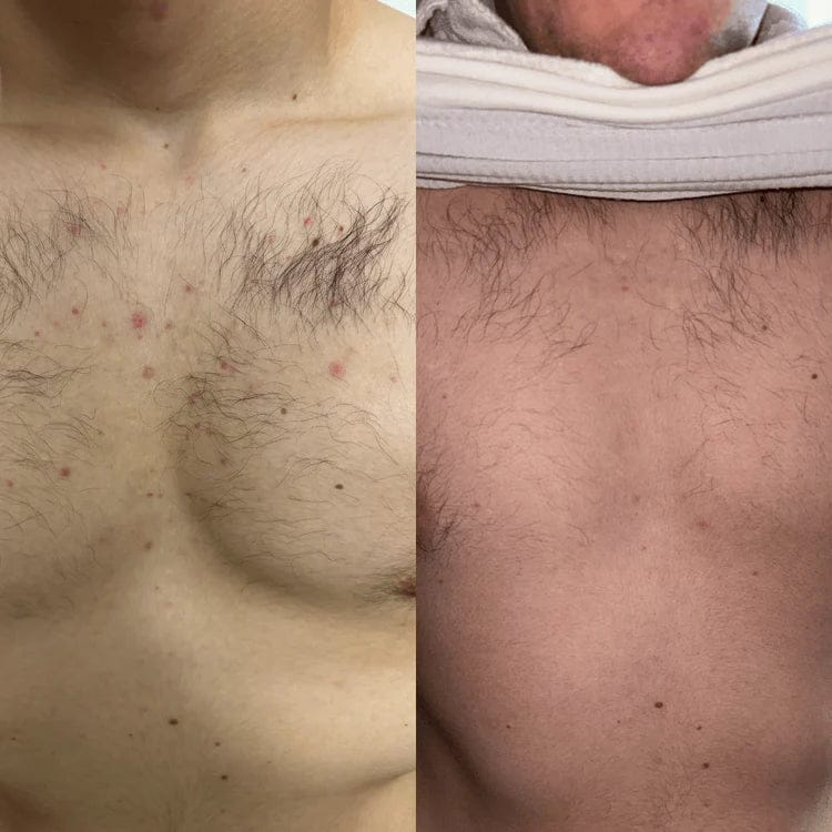 Customer photo review of Lucrown Body Acne Wash