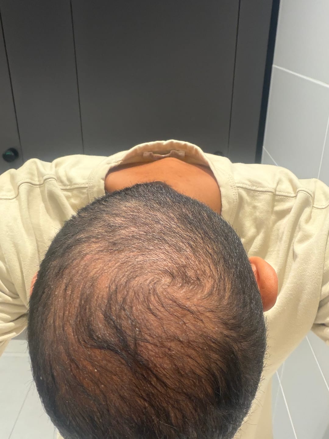 Customer photo review of RootFix™ | ערכה לטיפול בנשירה והתקרחות של השיער