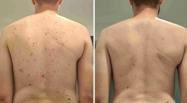 Customer photo review of Lucrown Body Acne Wash
