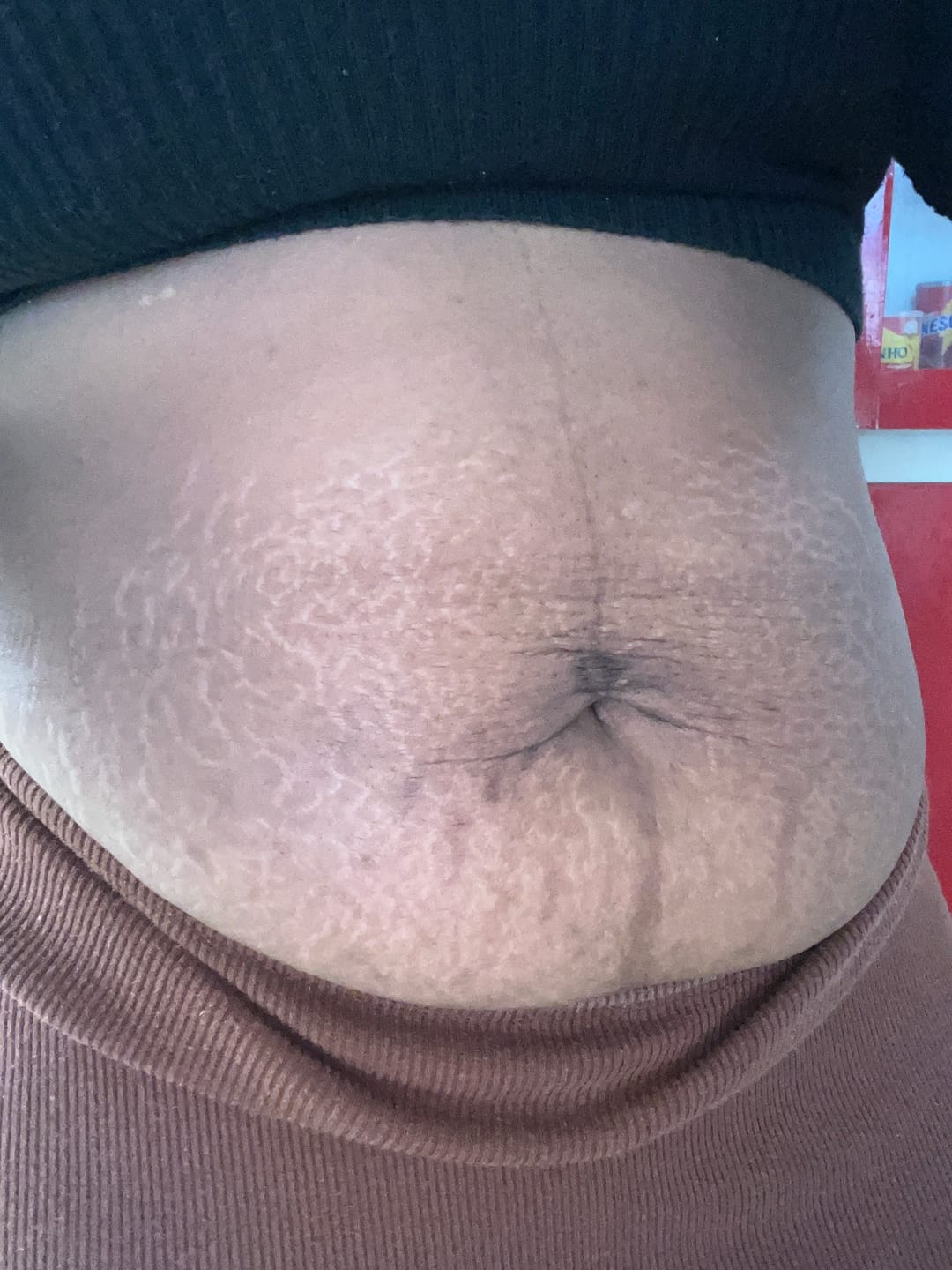 Customer photo review of Creme Antiestrias Regenerador Dérmico