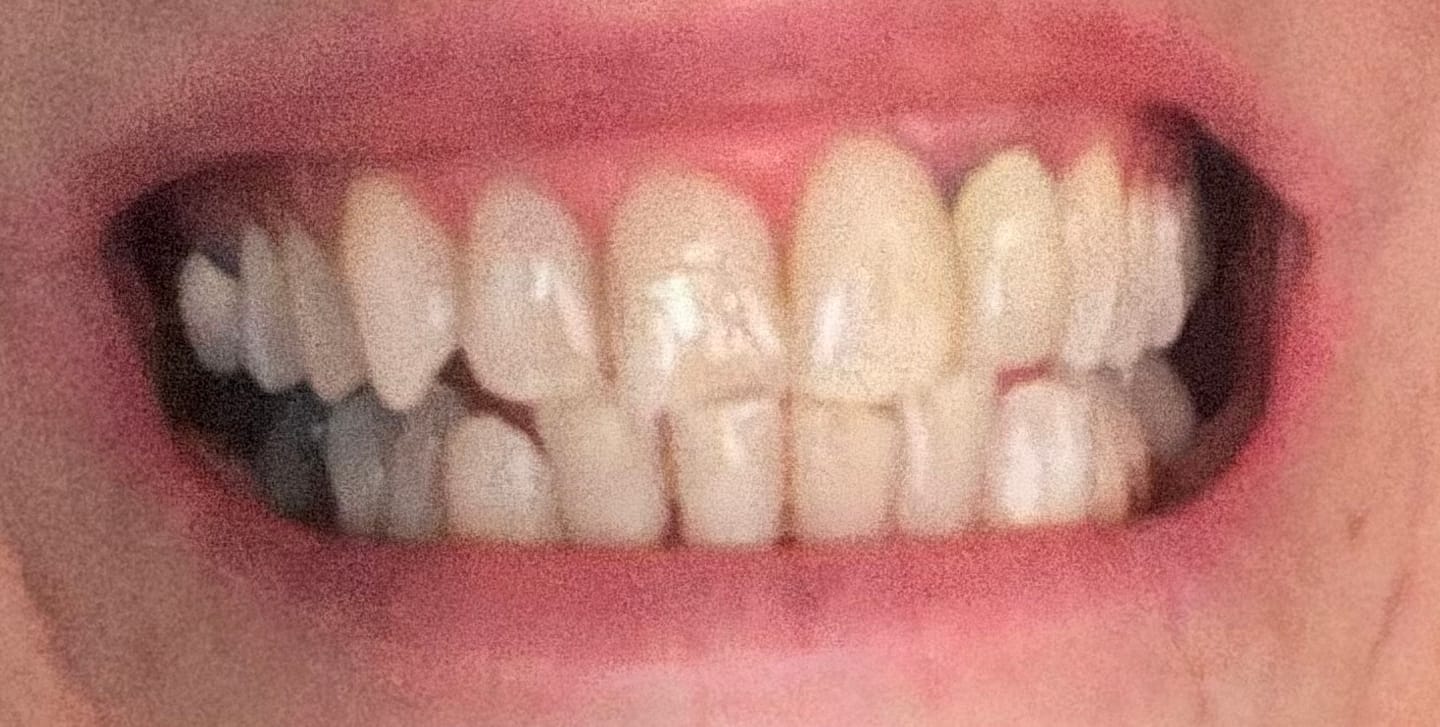 Customer photo review of Composite Care Bundle