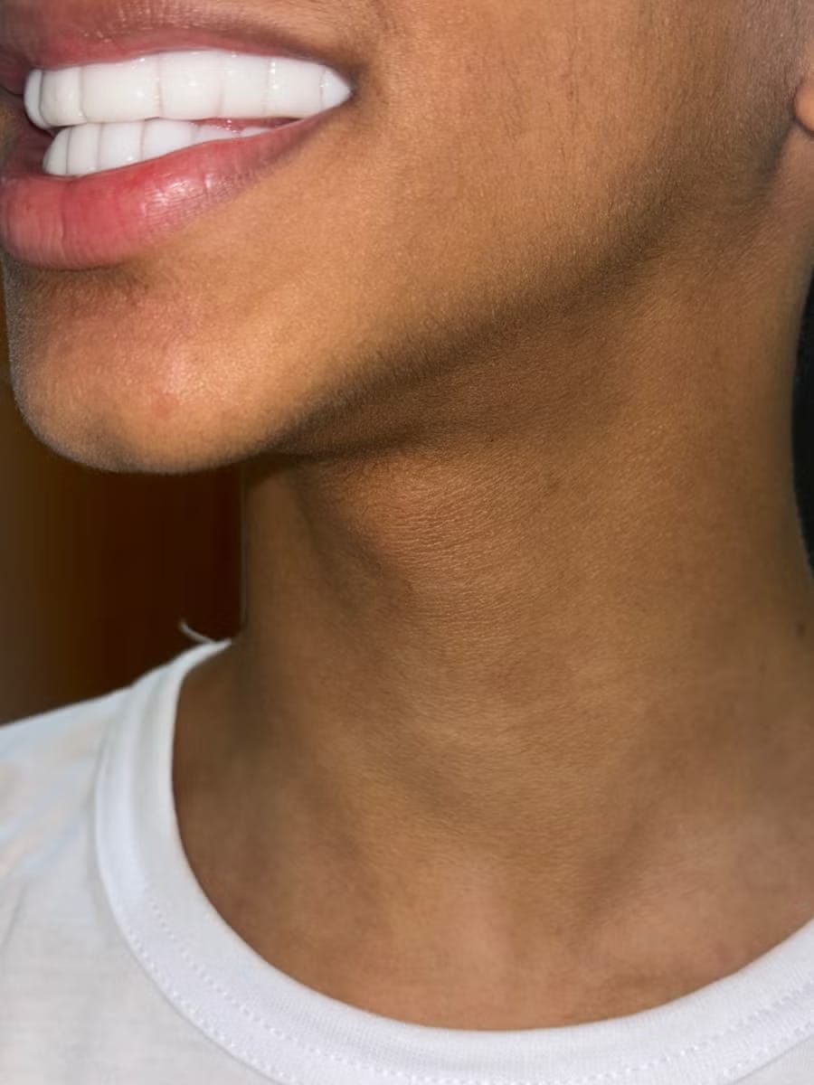 Customer photo review of Snap-On Veneers — Your Smile, Your Confidence (Pack of Two Veneers)
