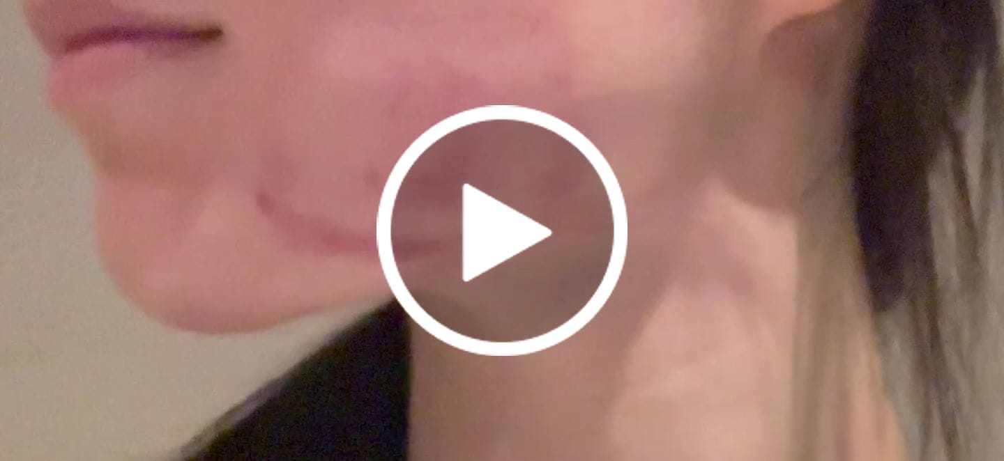 Customer video review of 来院診療｜インモードminiFX 1部位or2部位【Wellness Plus Clinic】
