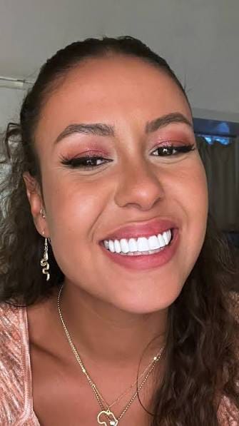 Customer photo review of Snap-On Veneers — Your Smile, Your Confidence (Pack of Two Veneers)