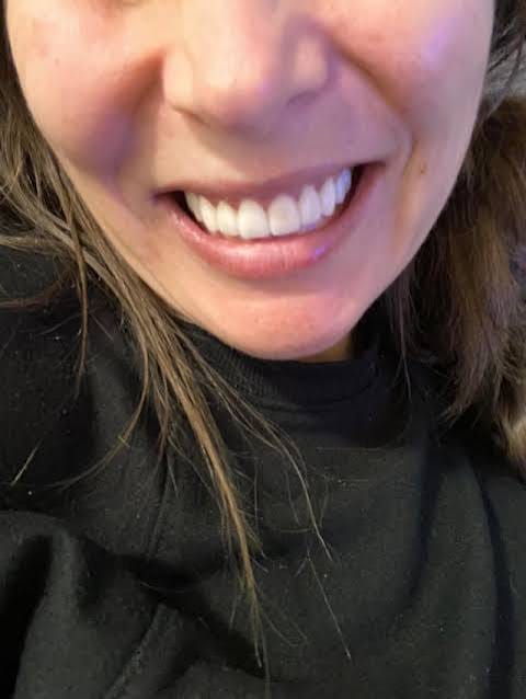 Customer photo review of Snap-On Veneers — Your Smile, Your Confidence (Pack of Two Veneers)