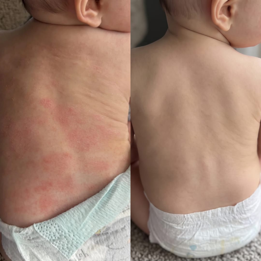 Customer photo review of Carezema Eczema Honey