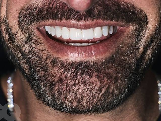 Customer photo review of Snap-On Veneers — Your Smile, Your Confidence (Pack of Two Veneers)