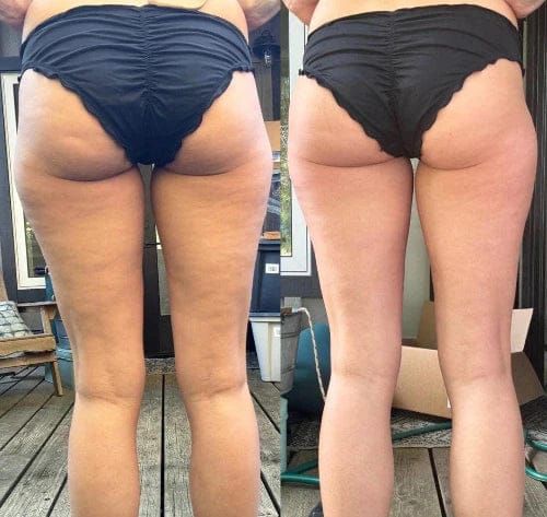Customer photo review of HYUME Sculpt Pro™ Professional Body Care Device