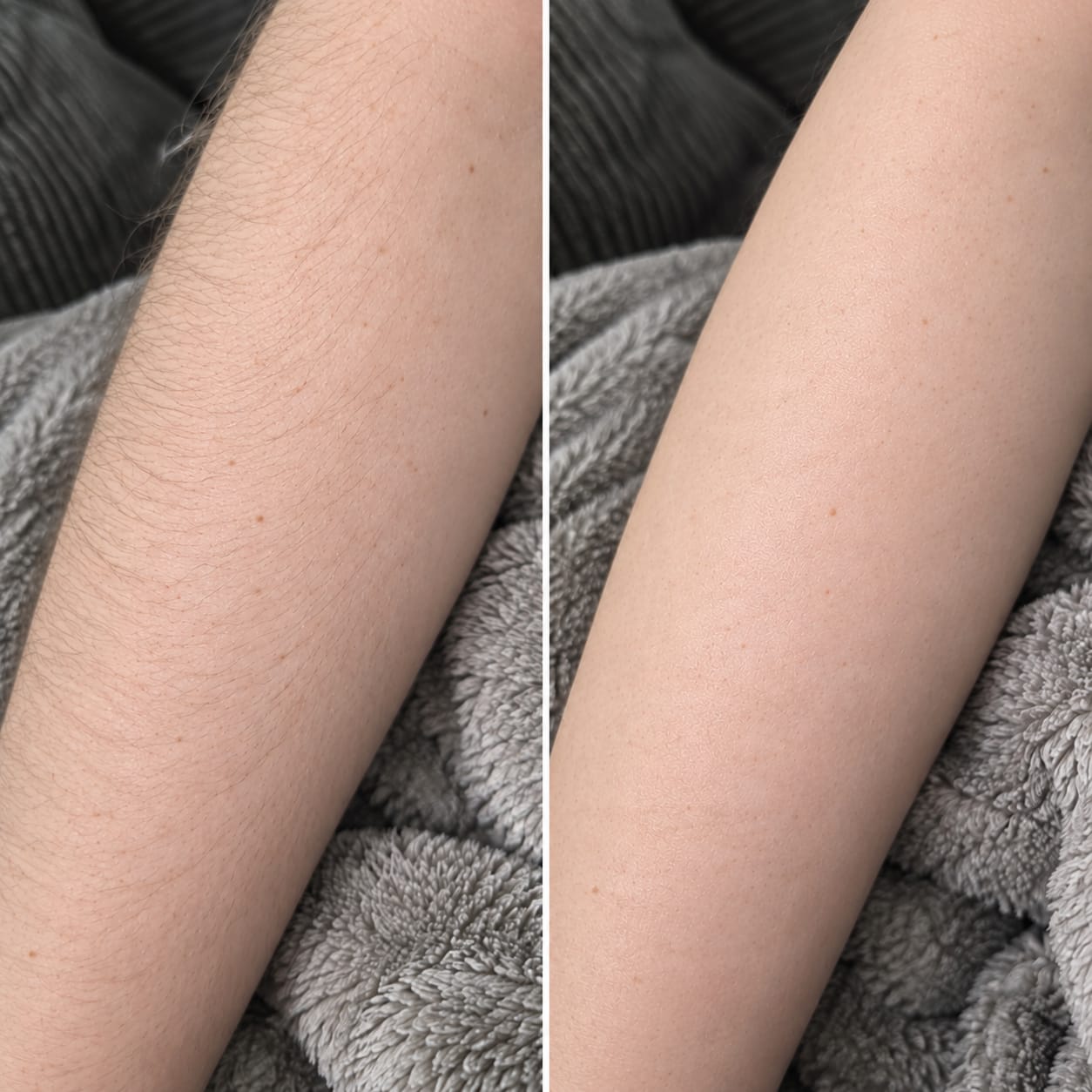 Customer photo review of CloudSense Pain-Free Hair Removal Foam Spray