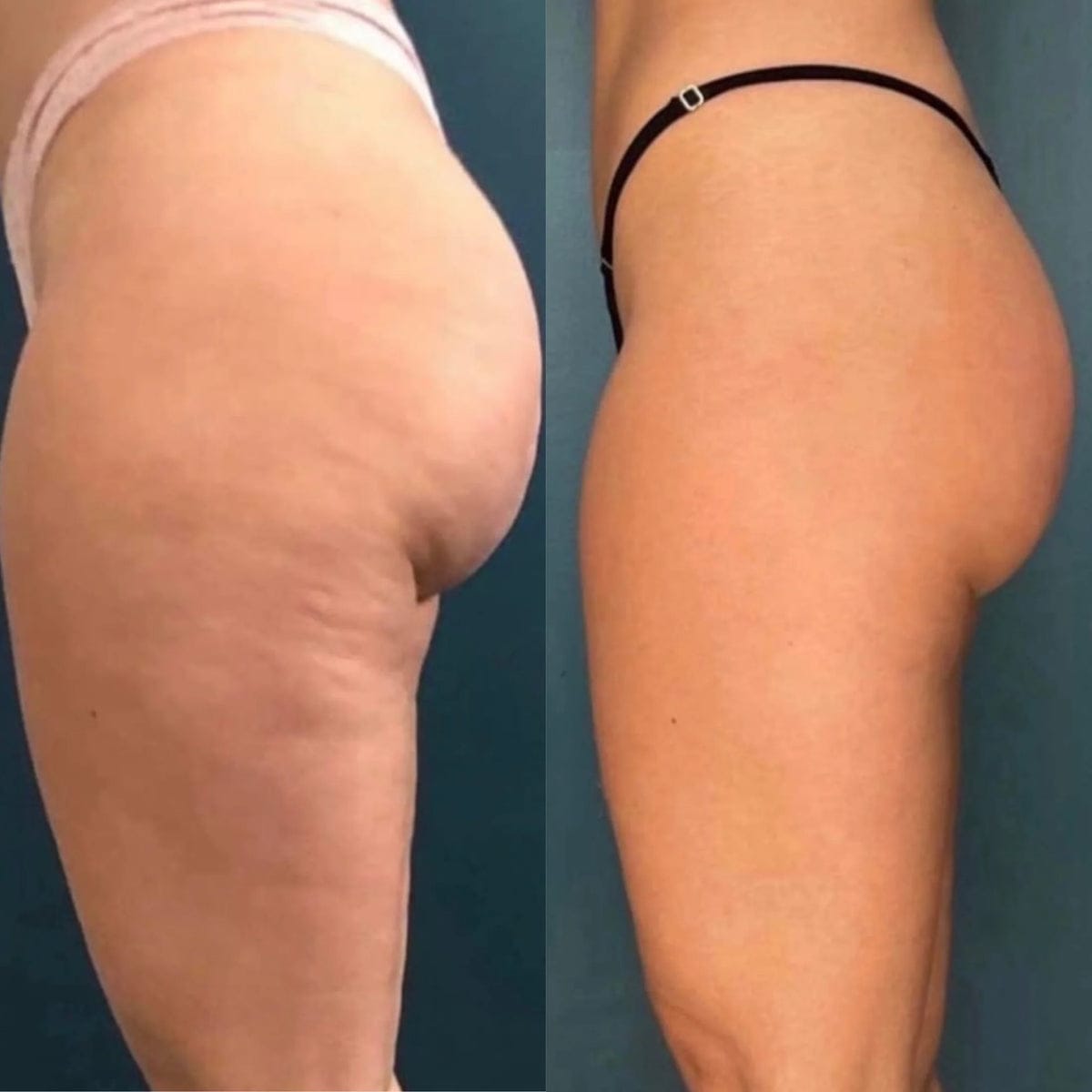 Customer photo review of HYUME Sculpt Pro™ Professional Body Care Device