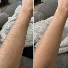 Customer photo review of CloudSense Pain-Free Hair Removal Foam Spray