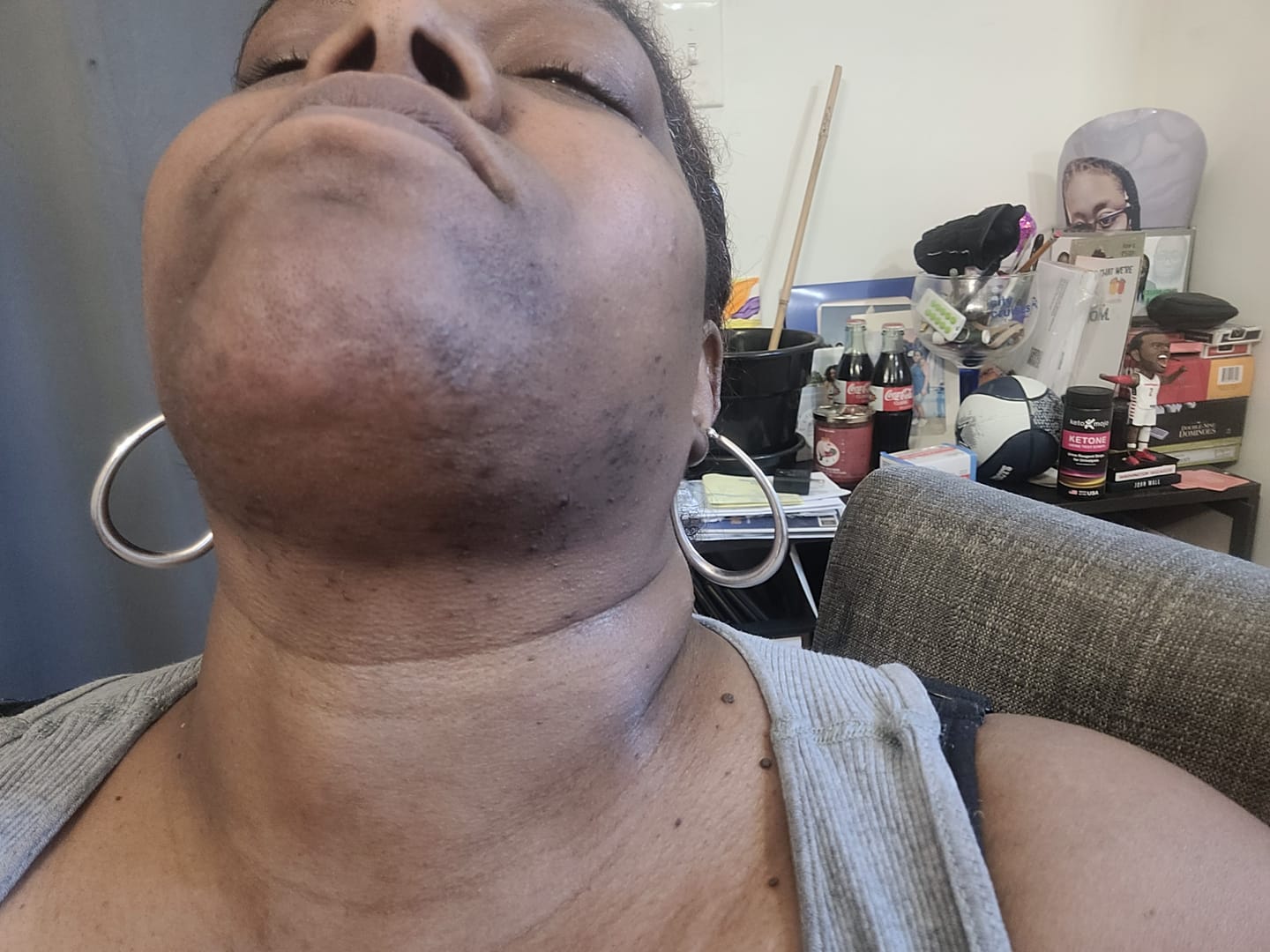 Customer photo review of Hair Reducing Fade Oil | For PCOS & Hirsutism-Related Facial Hair