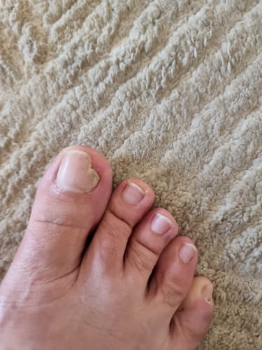 Customer's foot showing improvement in nail health while using Nutrichom Nail Defense & Restore.