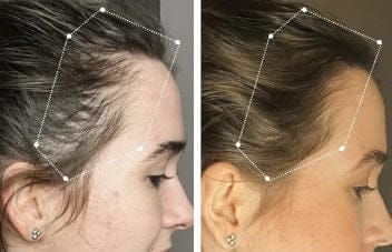Customer photo review of Scaléa | Peigne Massant & Applicateur de Soin pour Cuir Chevelu