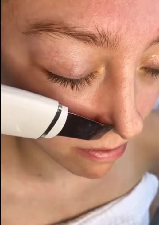 Customer photo review of Smoova™ — Ultrasonic Facial Cleanser 2.0