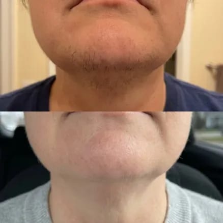Customer photo review of Aceite Reductor del Vello con Cyperus Rotundus