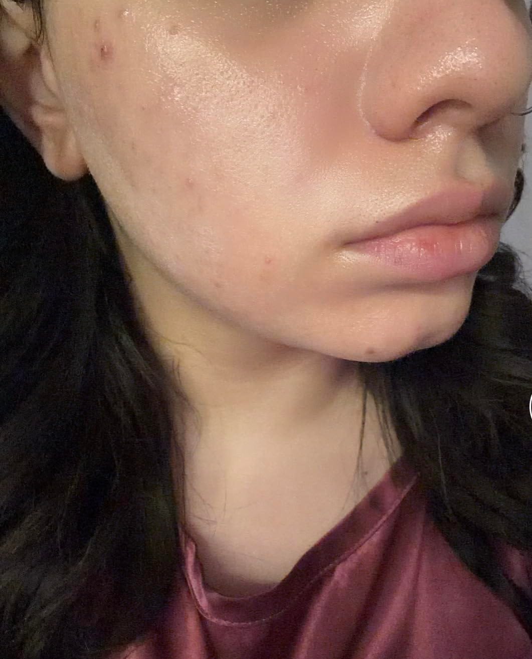 Customer photo review of Anua - Niacinamide 10 + TXA 4 Serum