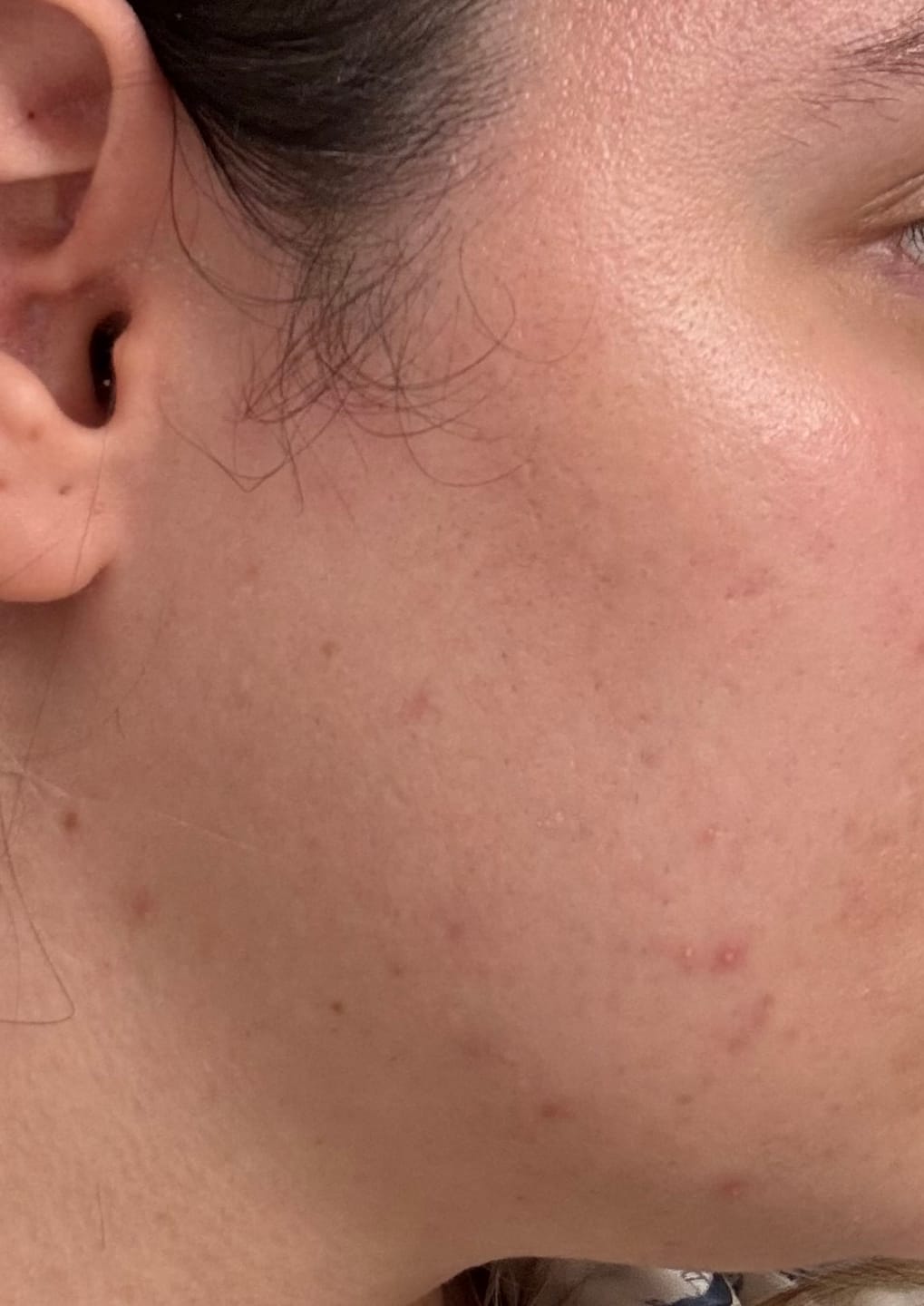 Customer photo review of A CONTROL - ACNÉ HORMONAL & RESISTENCIA A LA INSULINA