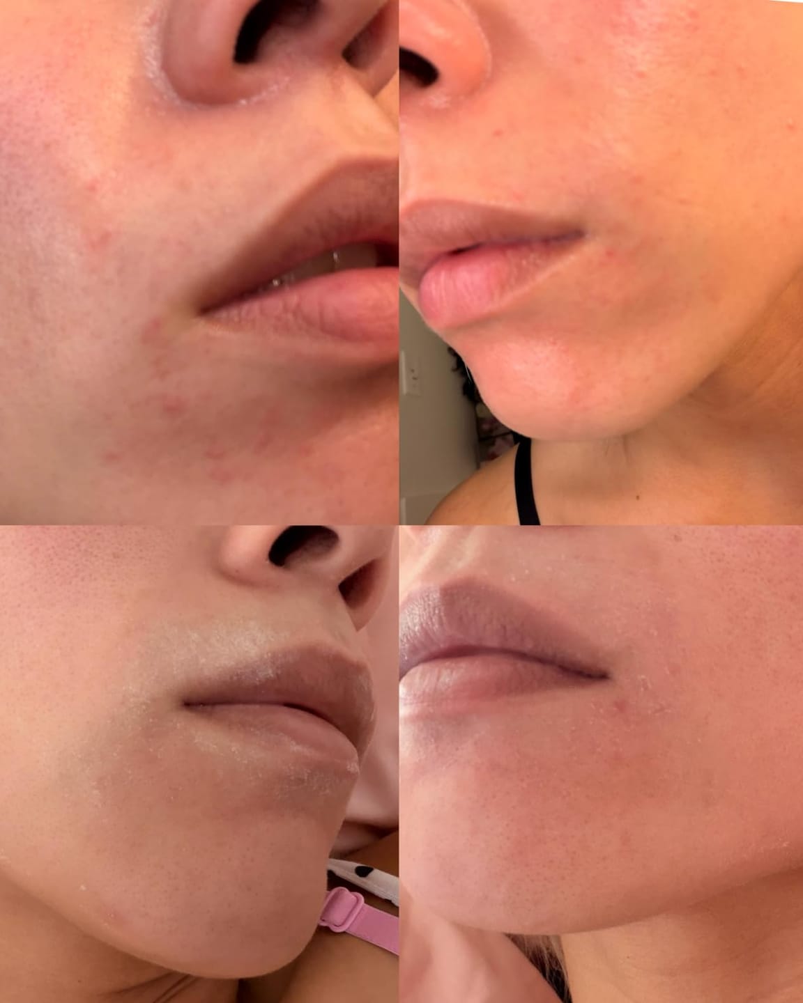 Customer photo review of Anua - Azelaic Acid 10 + Hyaluron Redness Soothing Serum