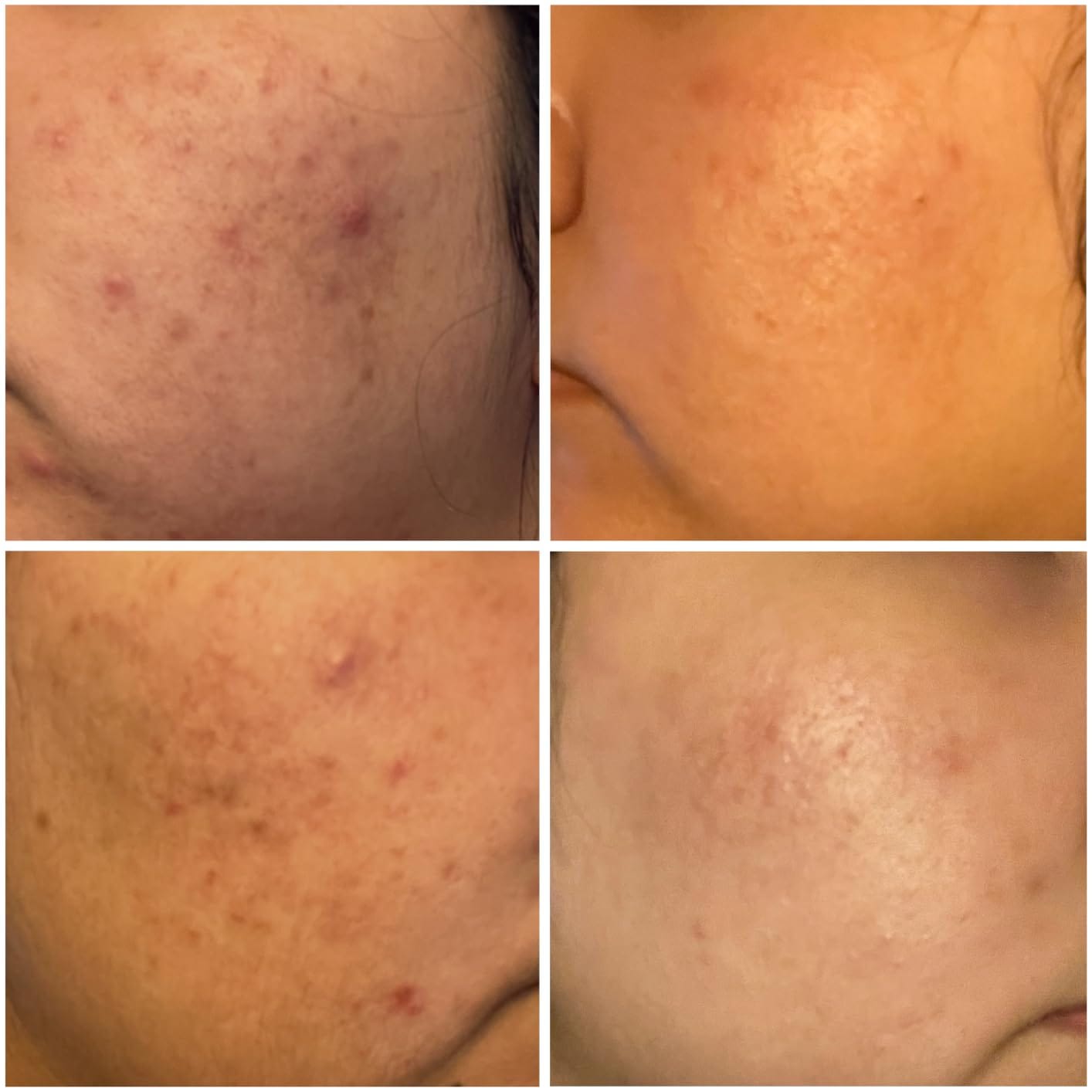Customer photo review of Anua - Azelaic Acid 10 + Hyaluron Redness Soothing Serum