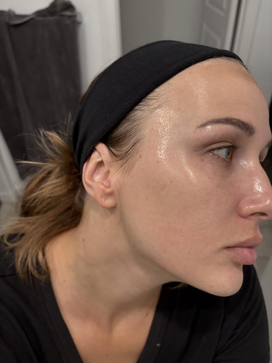 Customer photo review of Anua - Azelaic Acid 10 + Hyaluron Redness Soothing Serum