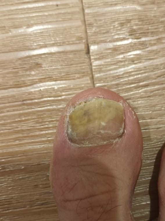 Customer photo review of NAGELPILZ Serum - Natürliche Formel mit Teebaumöl & Vitamin E - 10ml
