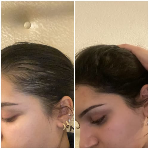 Reviewer's side-by-side comparison of scalp hair growth before and after using Complex10™ Hair Growth Supplement.