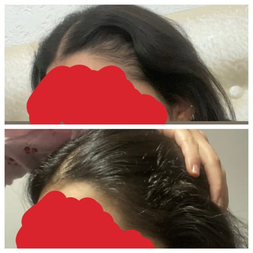 Customer's before and after photos showing hair growth progress while using VITA FOAM Hair Growth Formula.