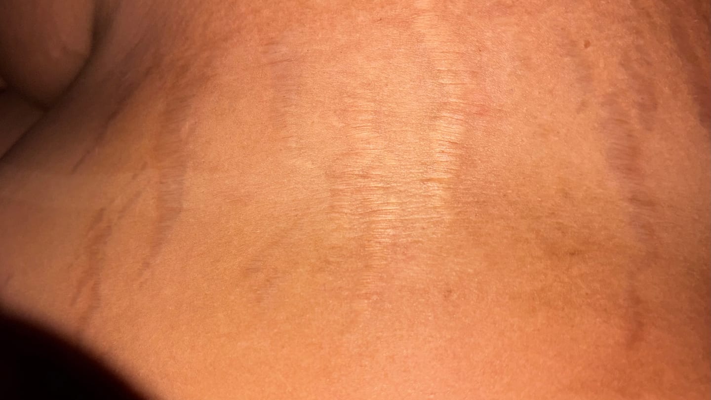 Customer photo review of Creme Antiestrias Regenerador Dérmico