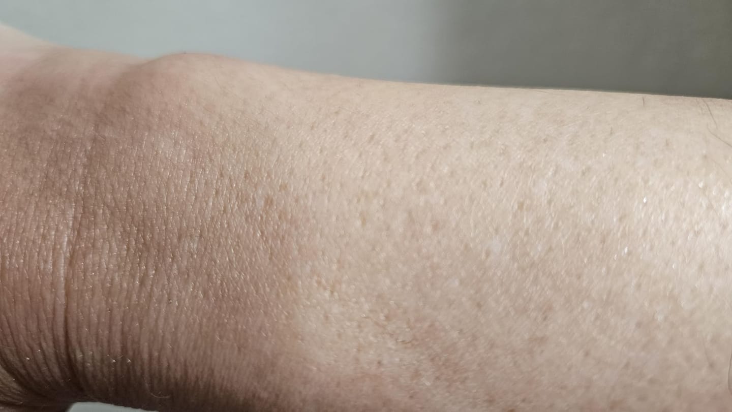 Customer photo review of CloudSense Pain-Free Hair Removal Foam Spray