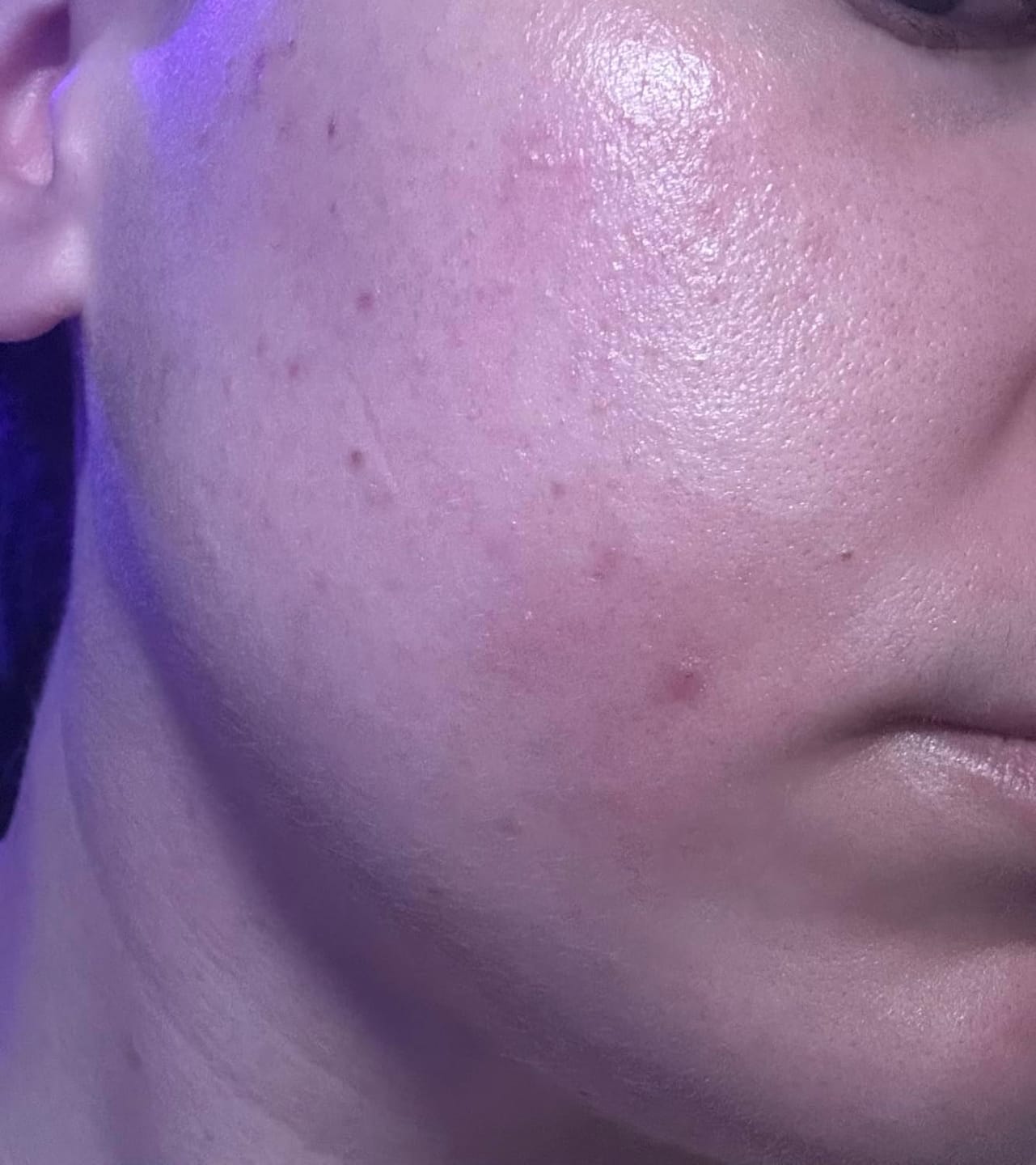 Customer photo review of Anua - Azelaic Acid 10 + Hyaluron Redness Soothing Serum