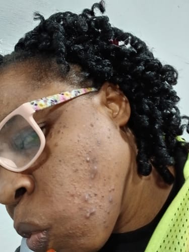 Customer photo review of Quia Turmeric & Kojic Acid Overnight Mask