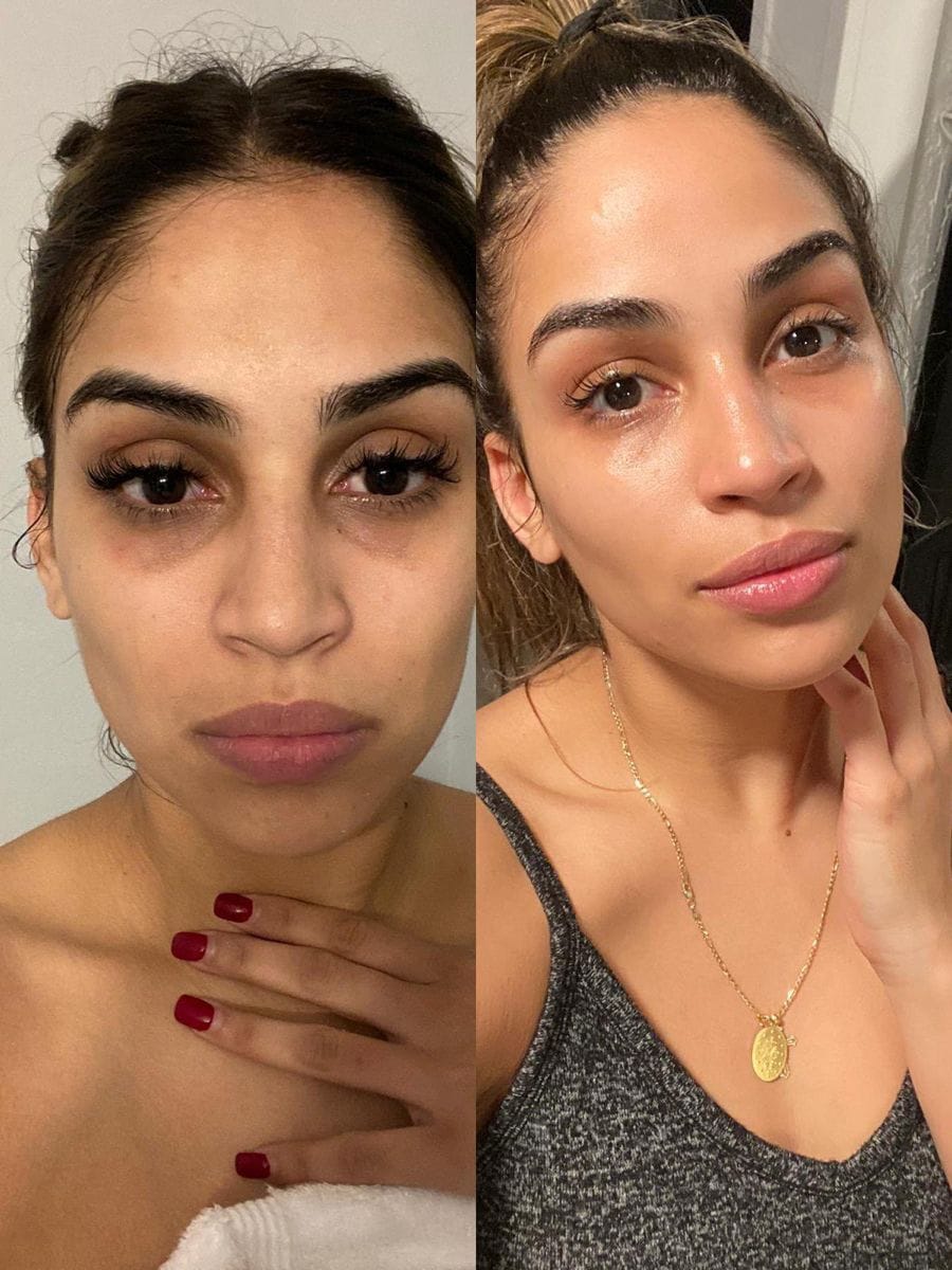 Customer photo review of NovaSculpt Glow — Alta Frecuencia para Piel Radiante y Sin Acné