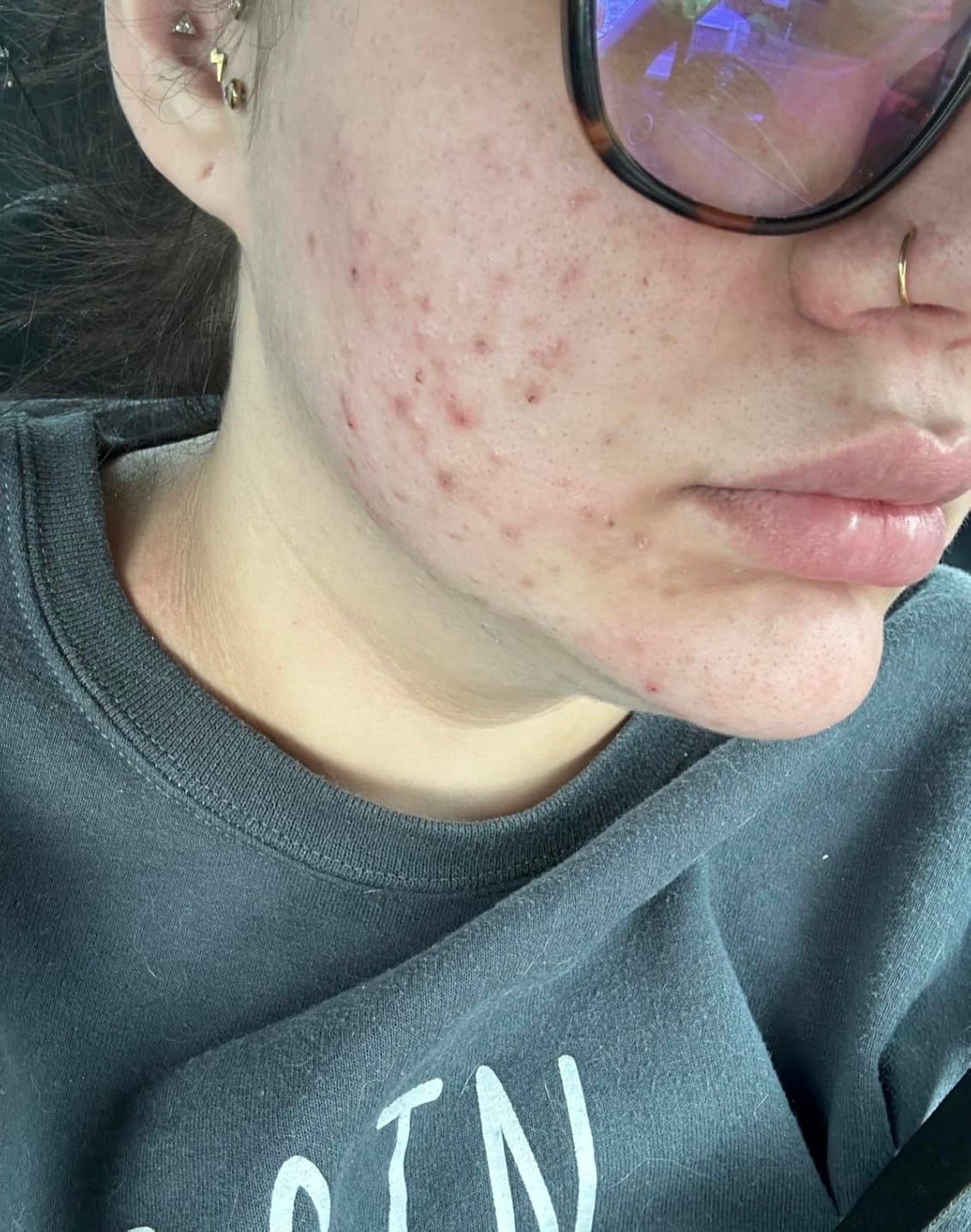 Customer photo review of Clear Complexion Skincare Set