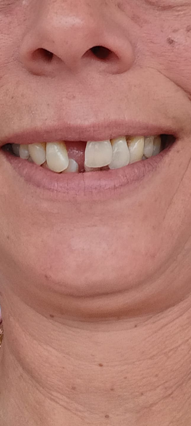 Customer photo review of Unilateral Partial Denture
