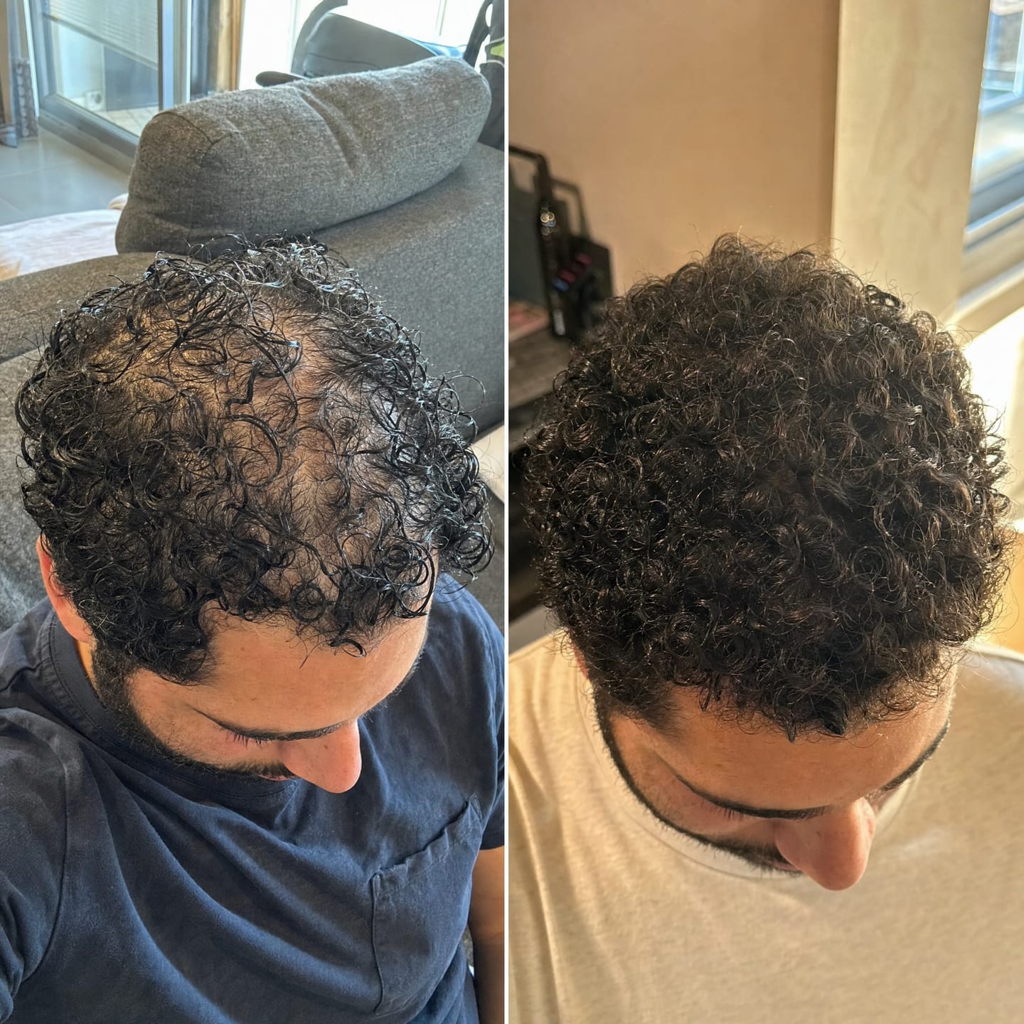 Customer photo review of RootFix™ | ערכה לטיפול בנשירה והתקרחות של השיער