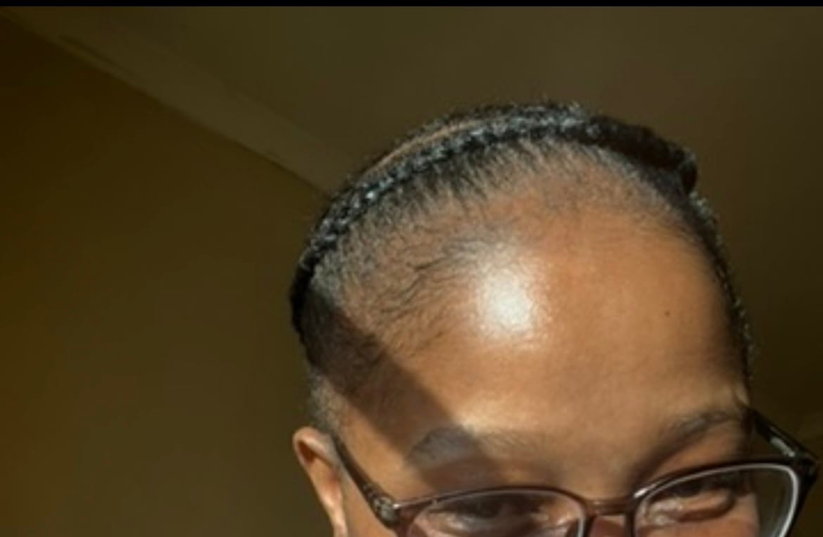 Customer photo review of Minoxidil 5% Foam, 1 x 60ml pack