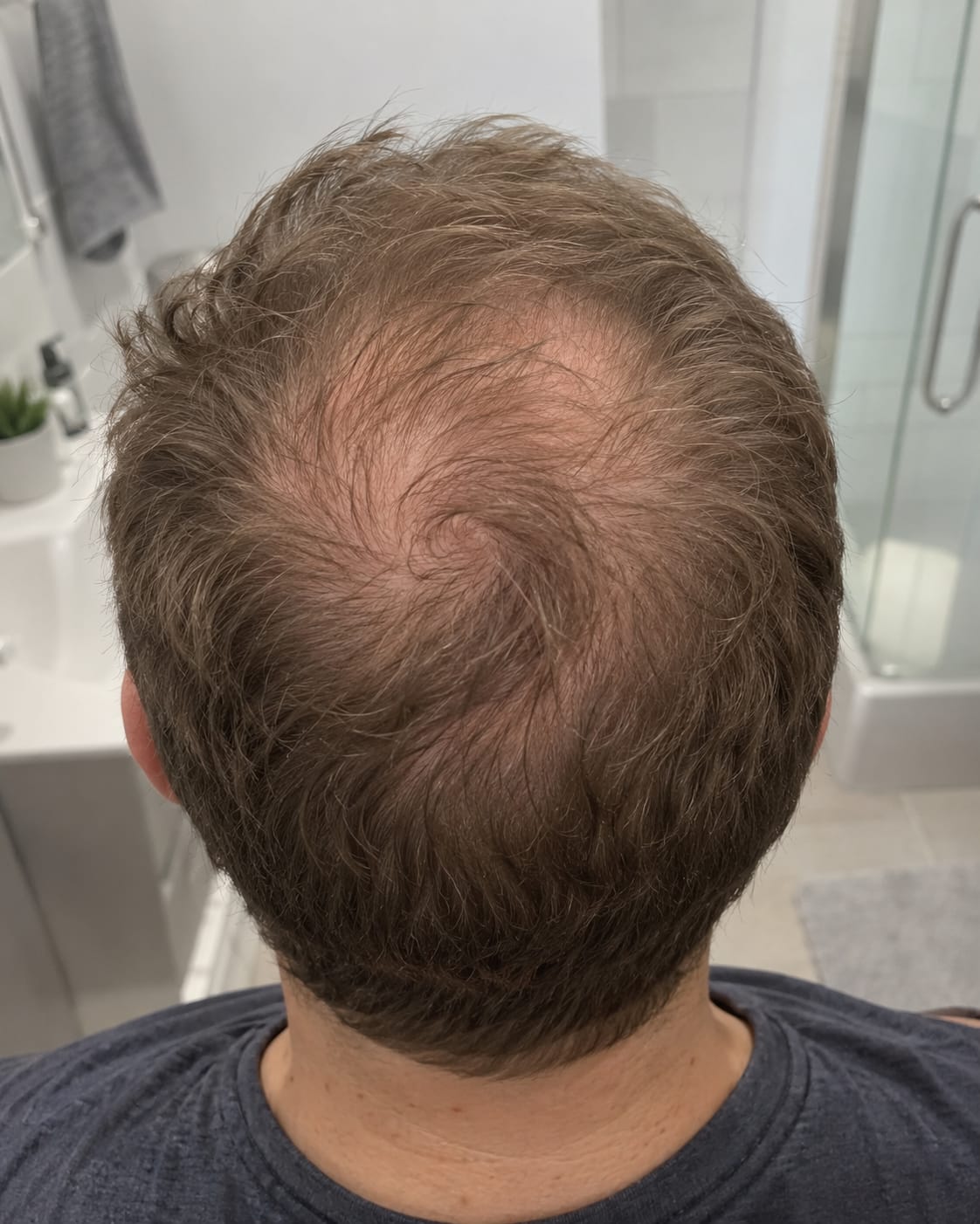 Customer photo review of Hair Regrowth Minoxidil Foam