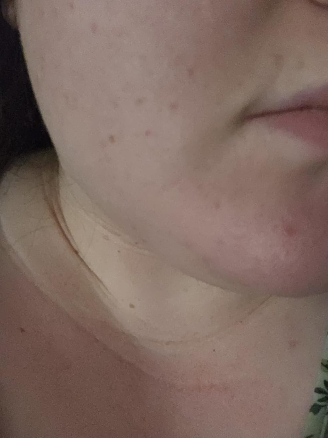 Customer photo review of Clear Complexion Skincare Set