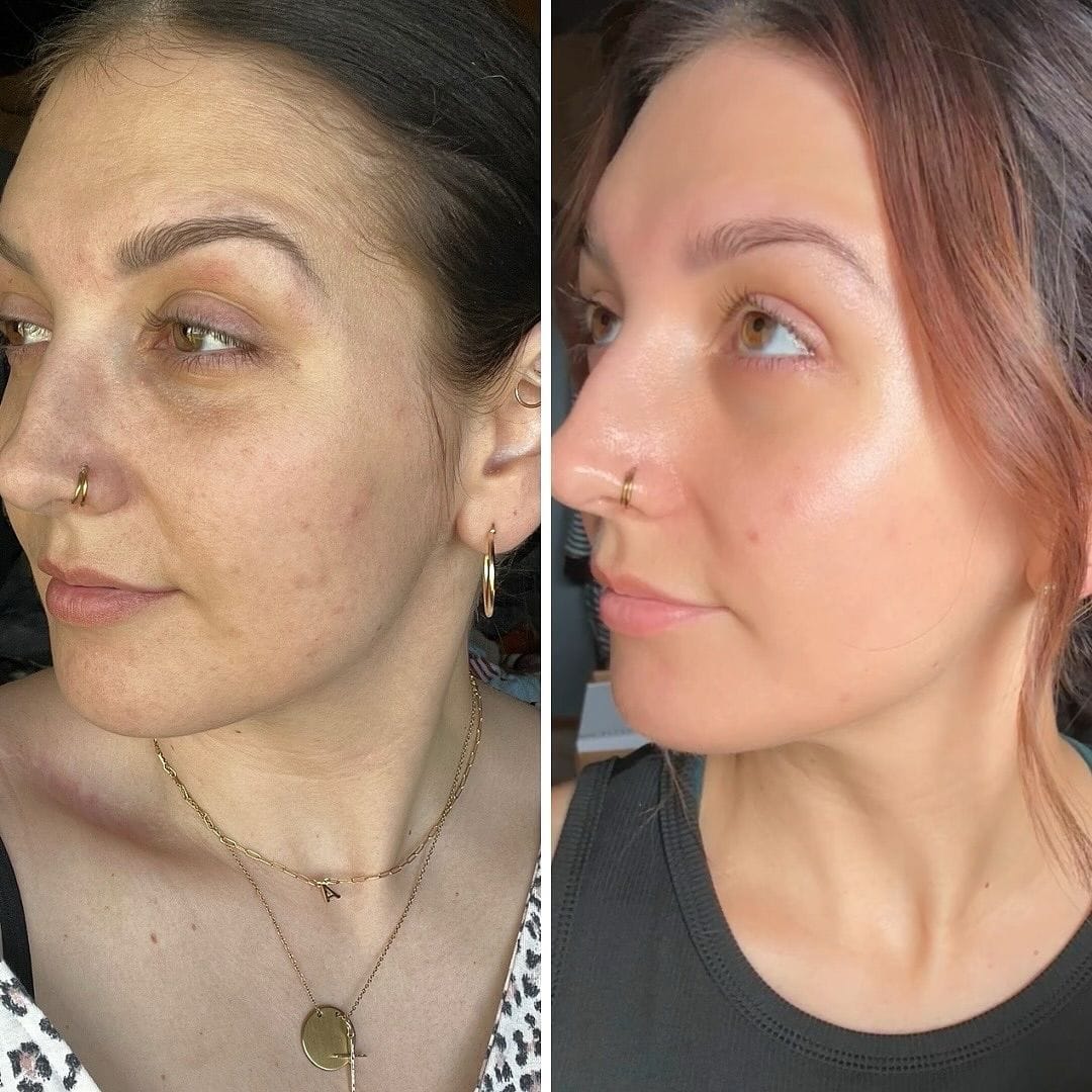 Customer photo review of NovaSculpt Glow — Alta Frecuencia para Piel Radiante y Sin Acné