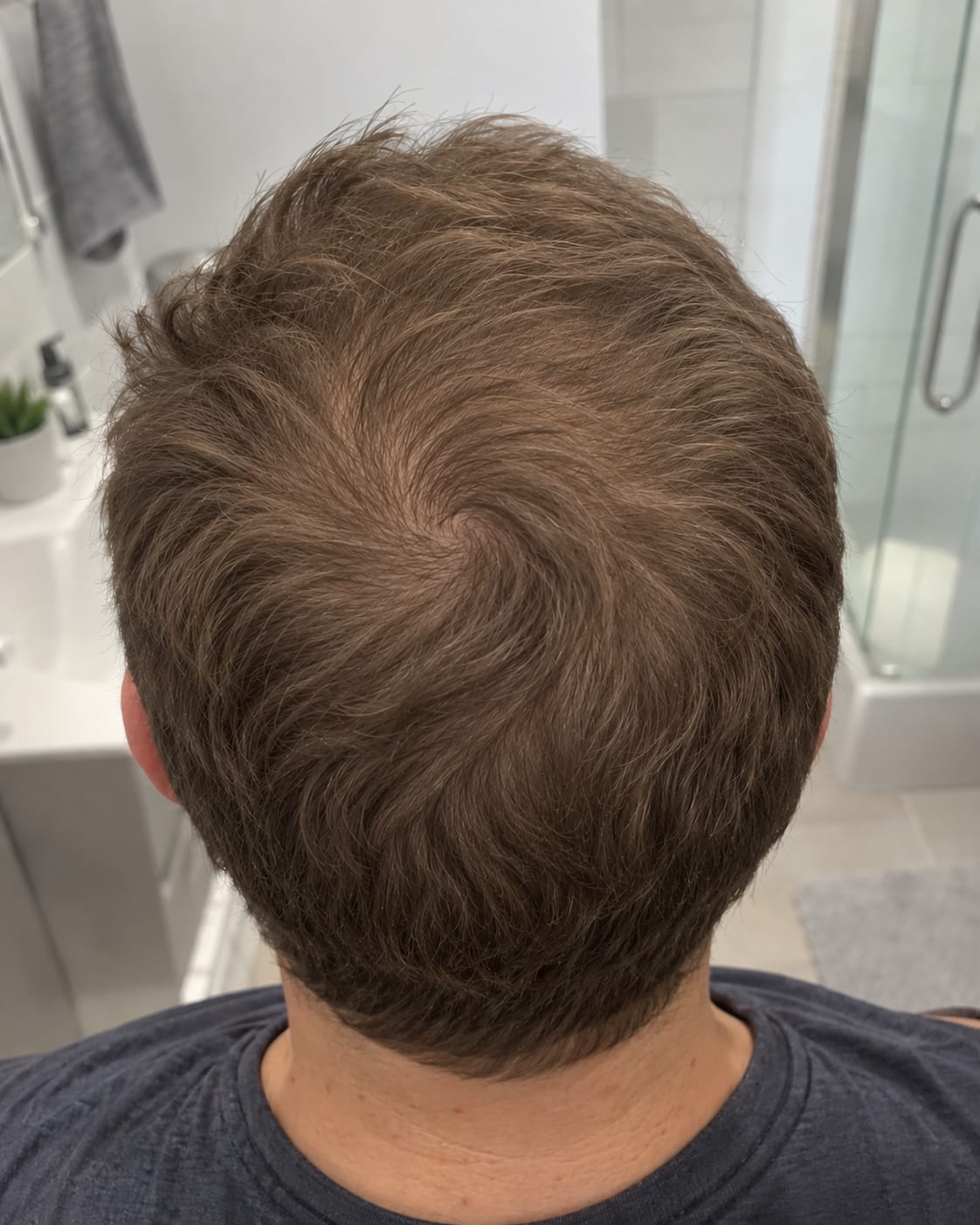 Customer photo review of Hair Regrowth Minoxidil Foam