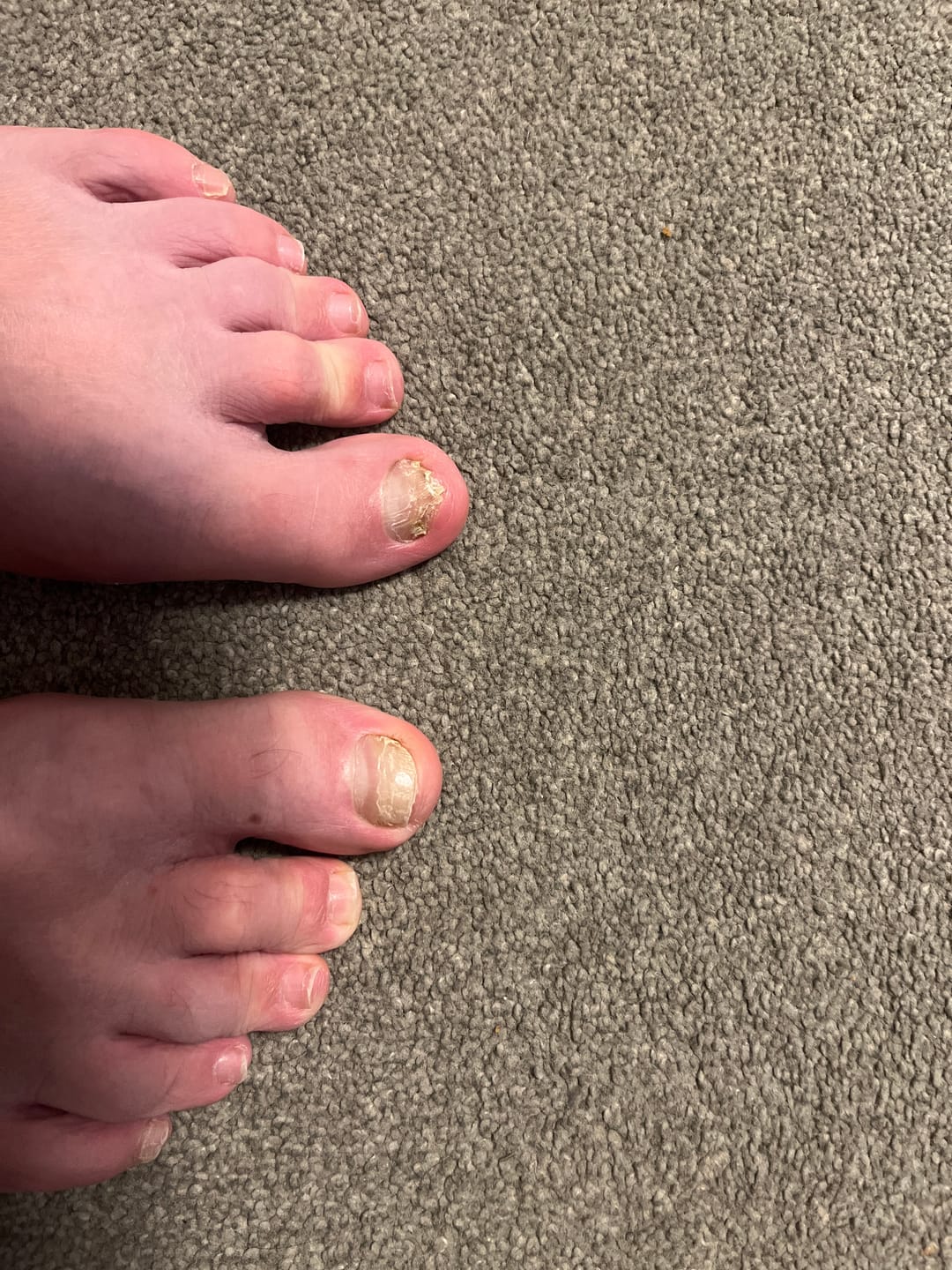 Customer photo review of VELCURA™ Fungal Nail Patches